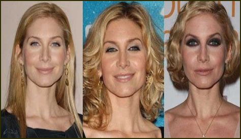 Elizabeth Mitchell Plastic Surgery Before and After